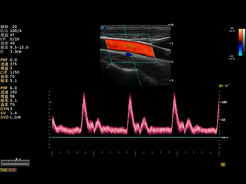 颈动脉PW